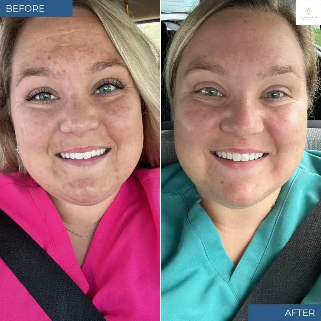 Bbl Moxi Before & After