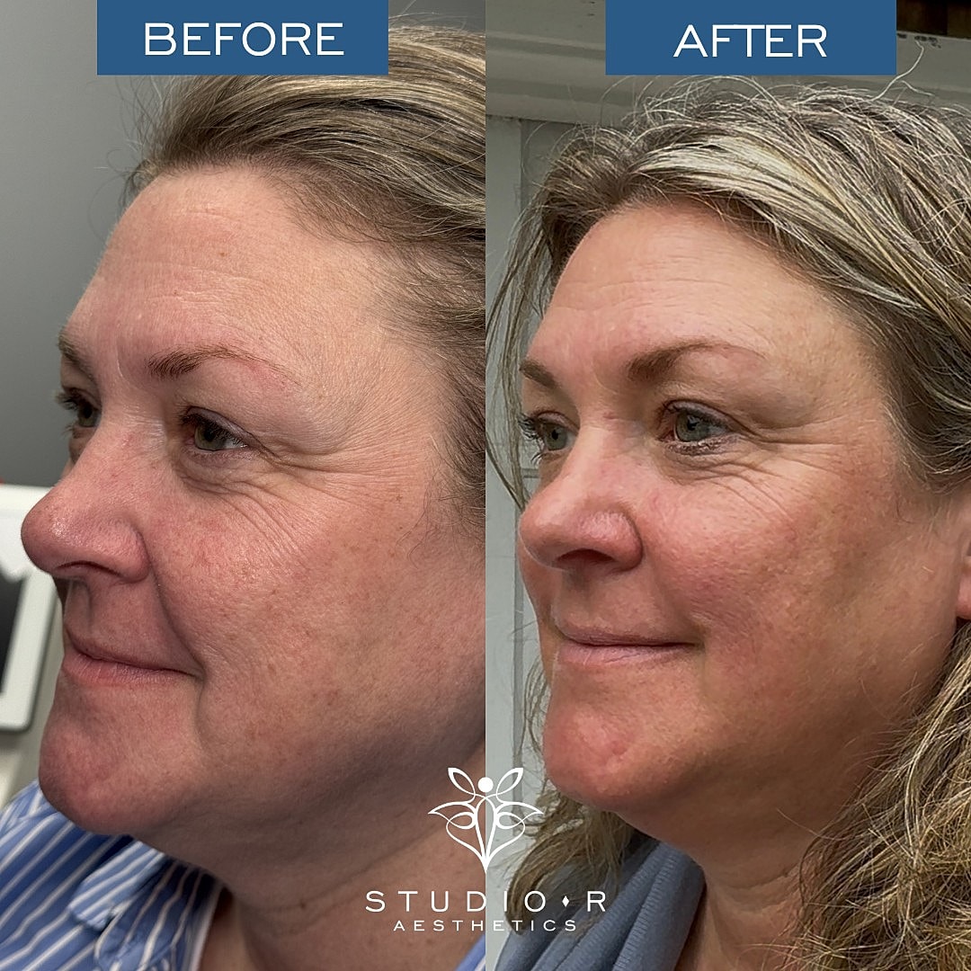 Bbl Moxi Before & After