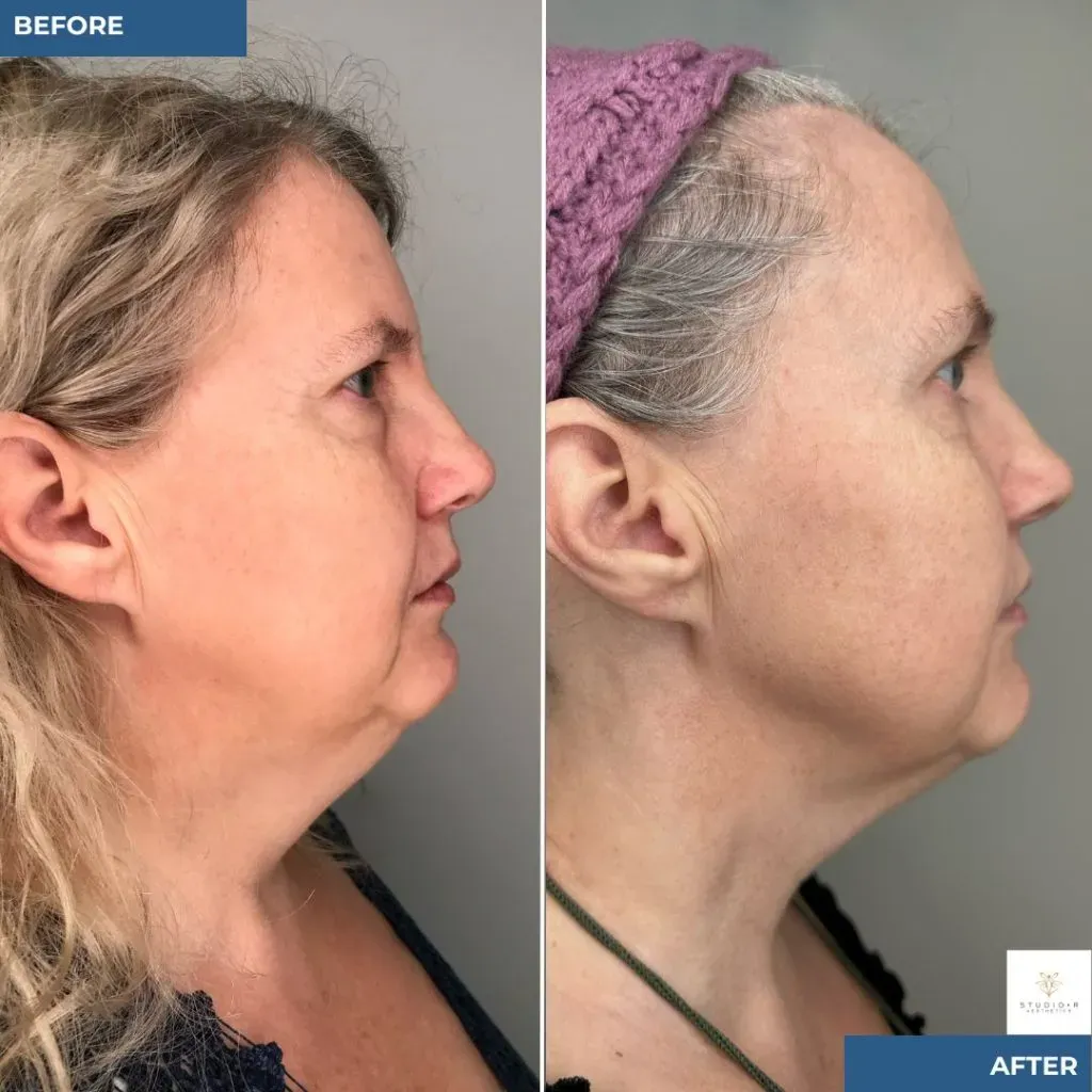 Rf Microneedling Before & After