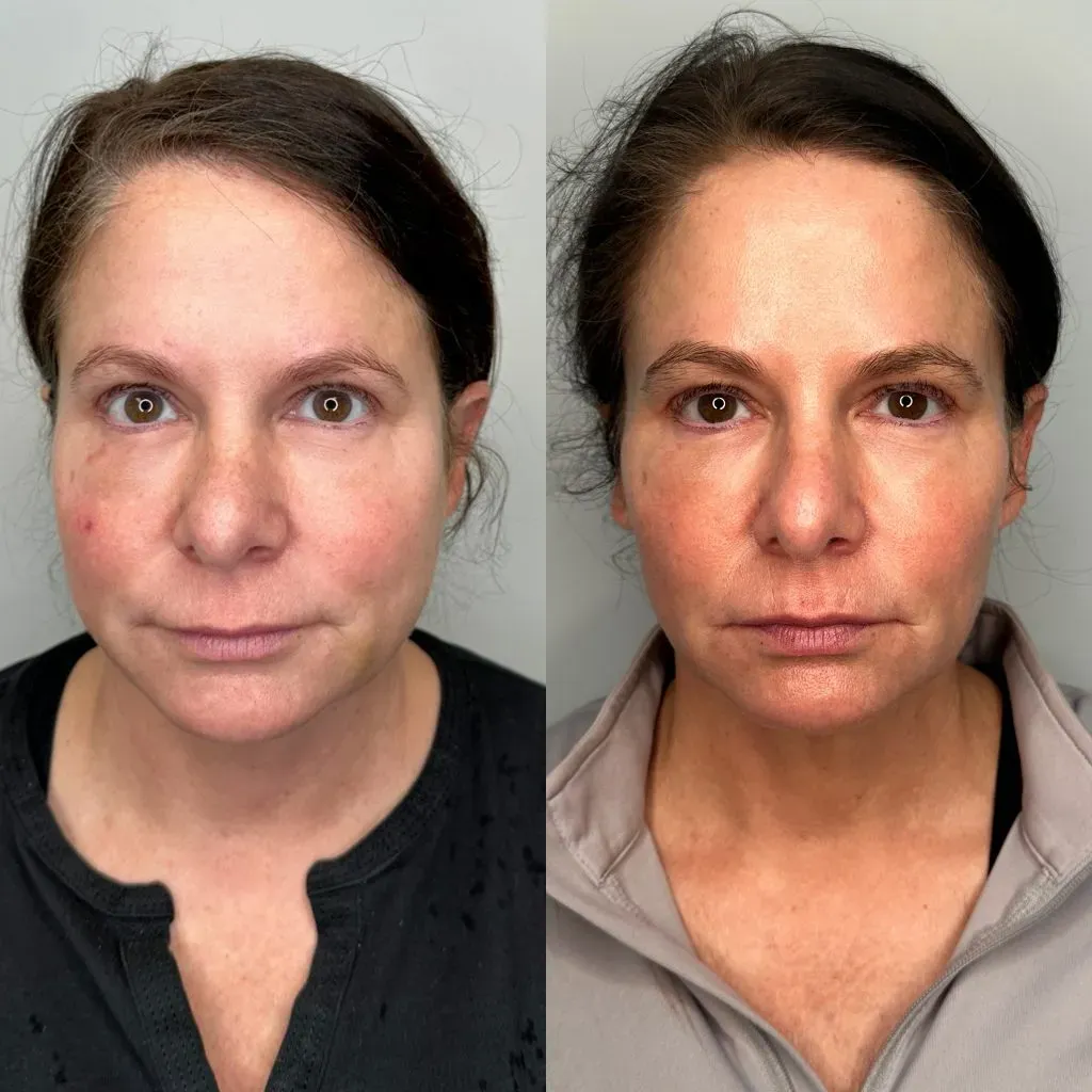 Rf Microneedling Before & After