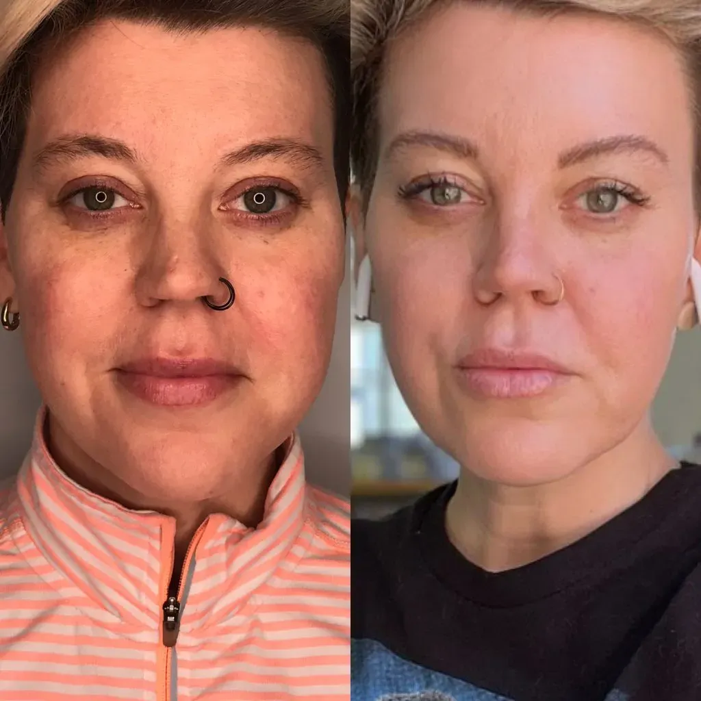 Rf Microneedling Before & After