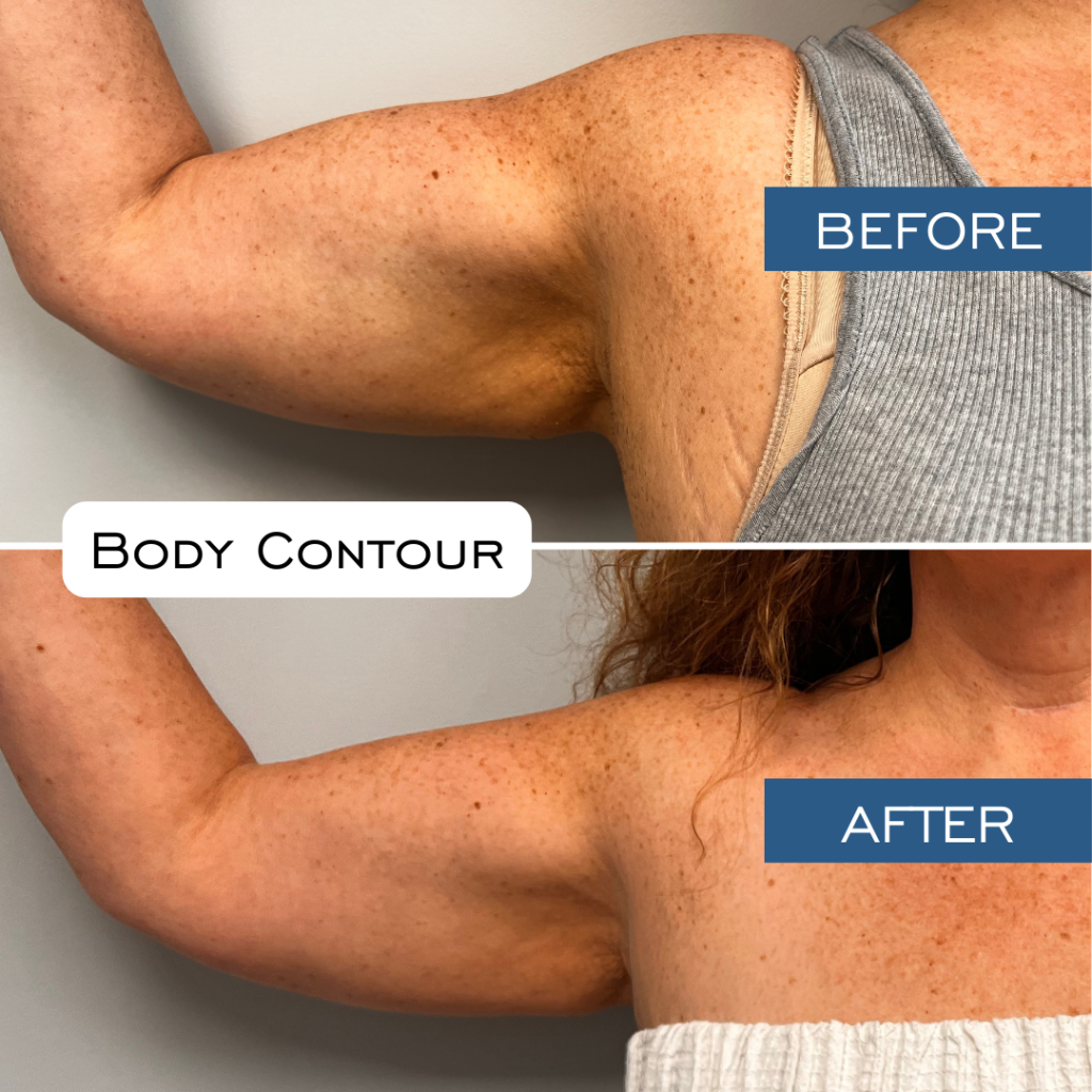 Rf Microneedling Before & After