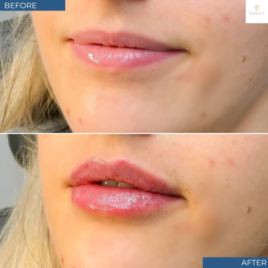 Lip Filler Before & After