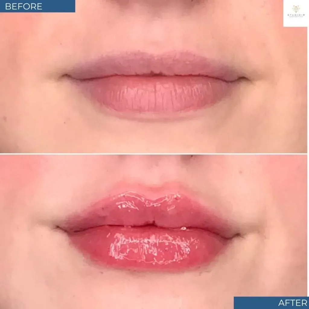 Lip Filler Before & After