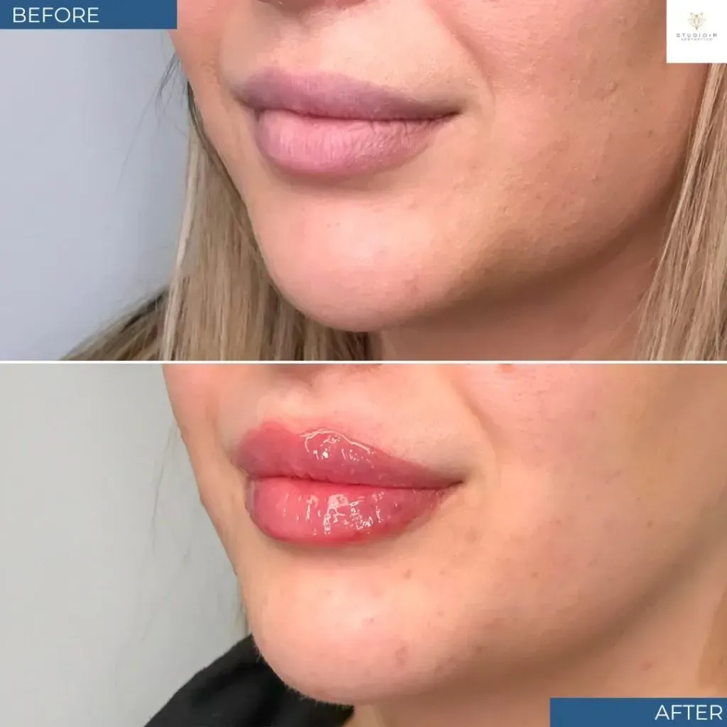 Lip Filler Before & After