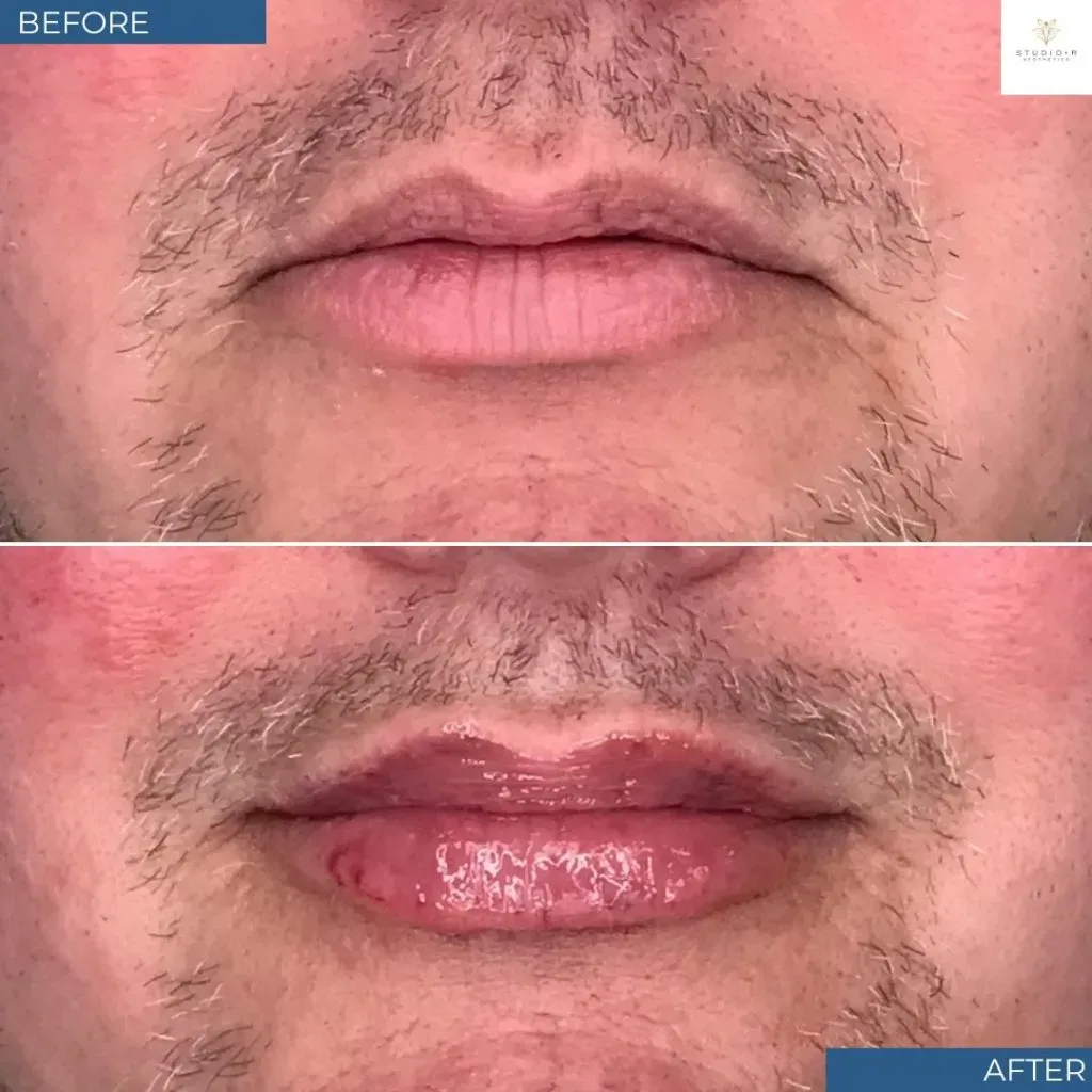Lip Filler Before & After