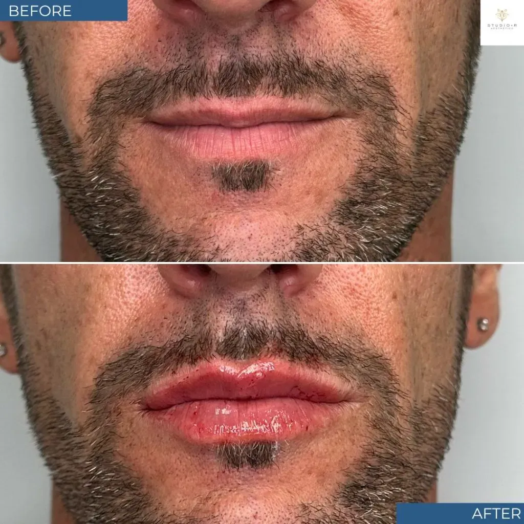 Lip Filler Before & After