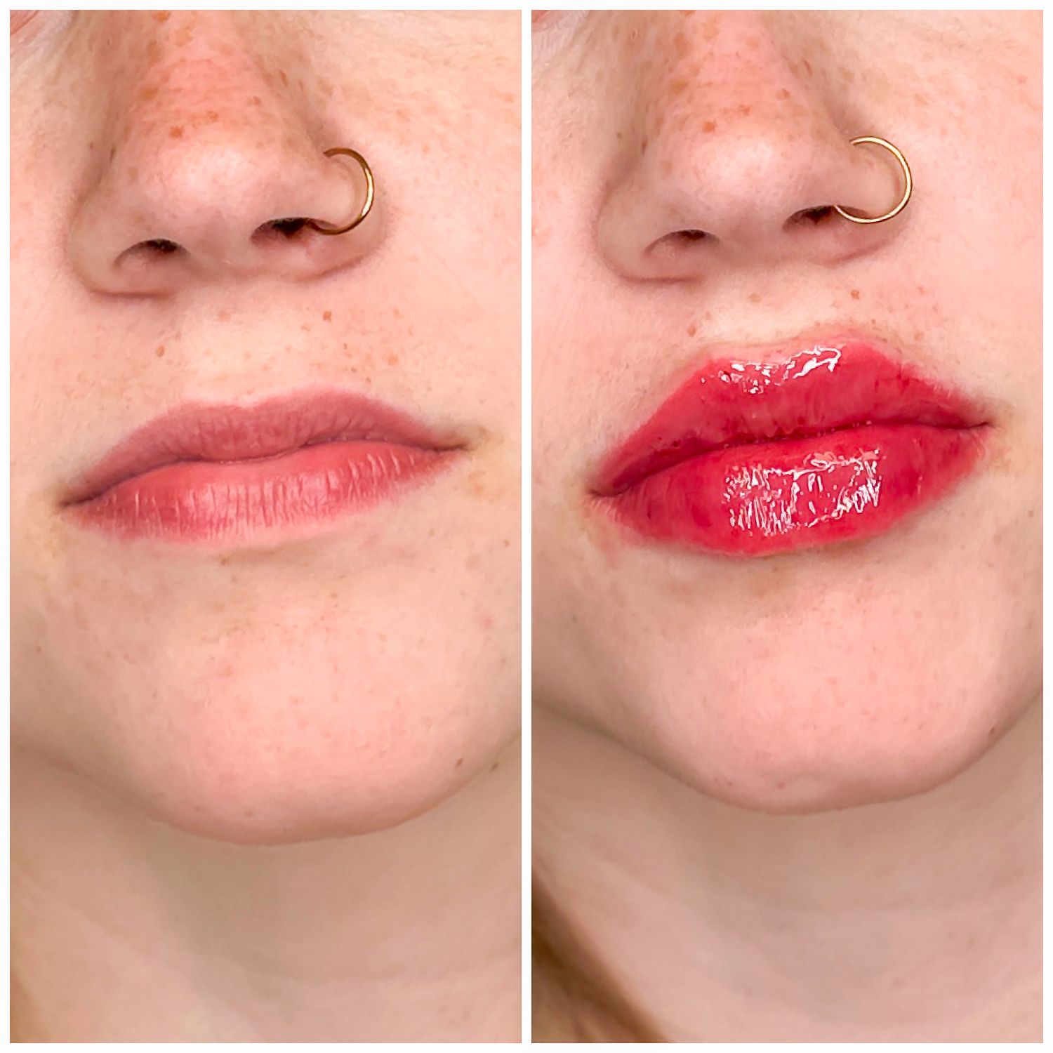 Lip Filler Before & After