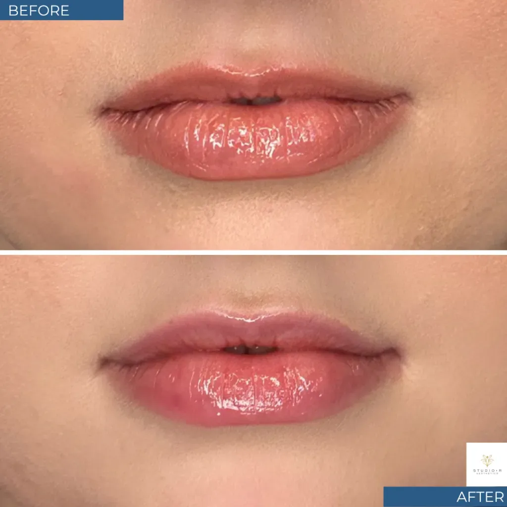 Botox Before & After