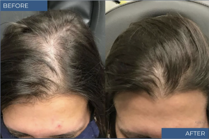 Hair Loss Before & After