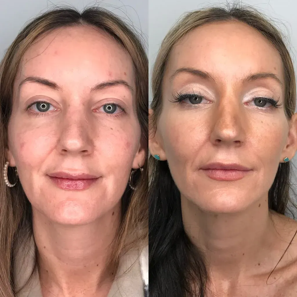 Coolpeel Deka Before & After
