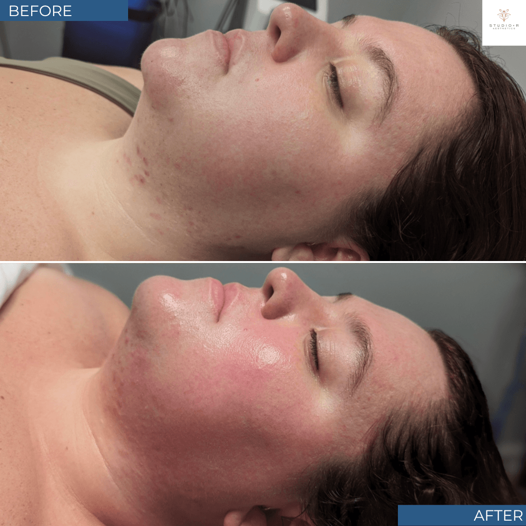 BBL Clear Acne Before and After at Studio R Aesthetics in Charlottesville Virginia