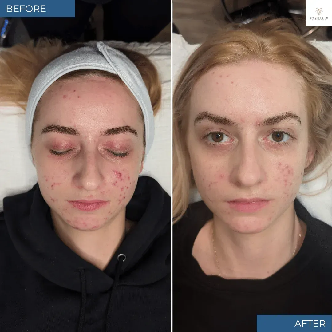 BBL CLEAR Before and After for Acne Treatment - Post 2 Sessions